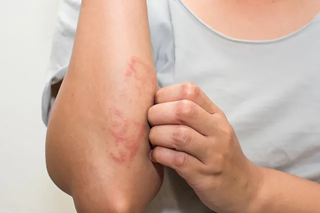 Managing Allergic Reactions